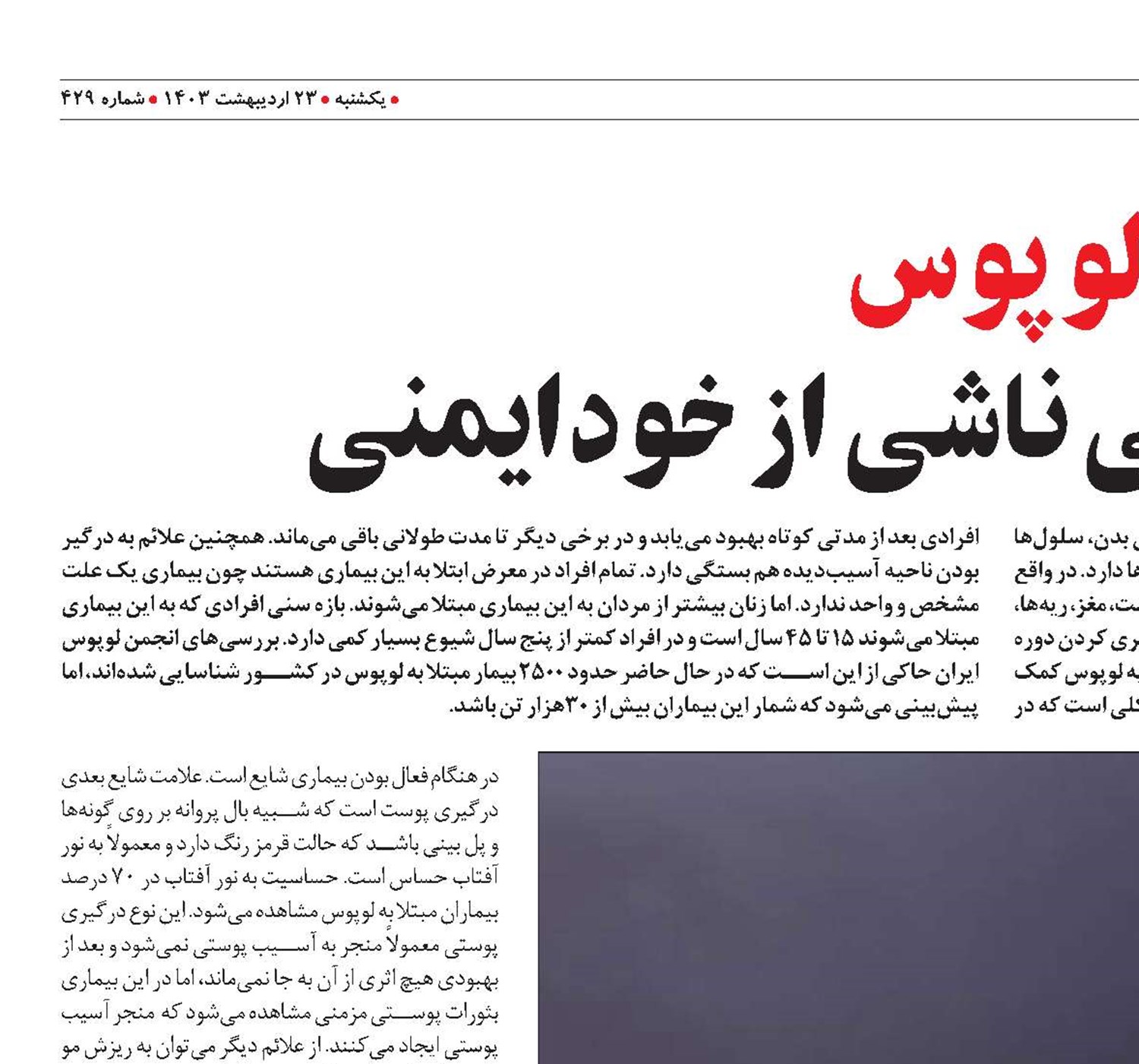 لوپوس بیماری پوستی ناشی از خودایمنی