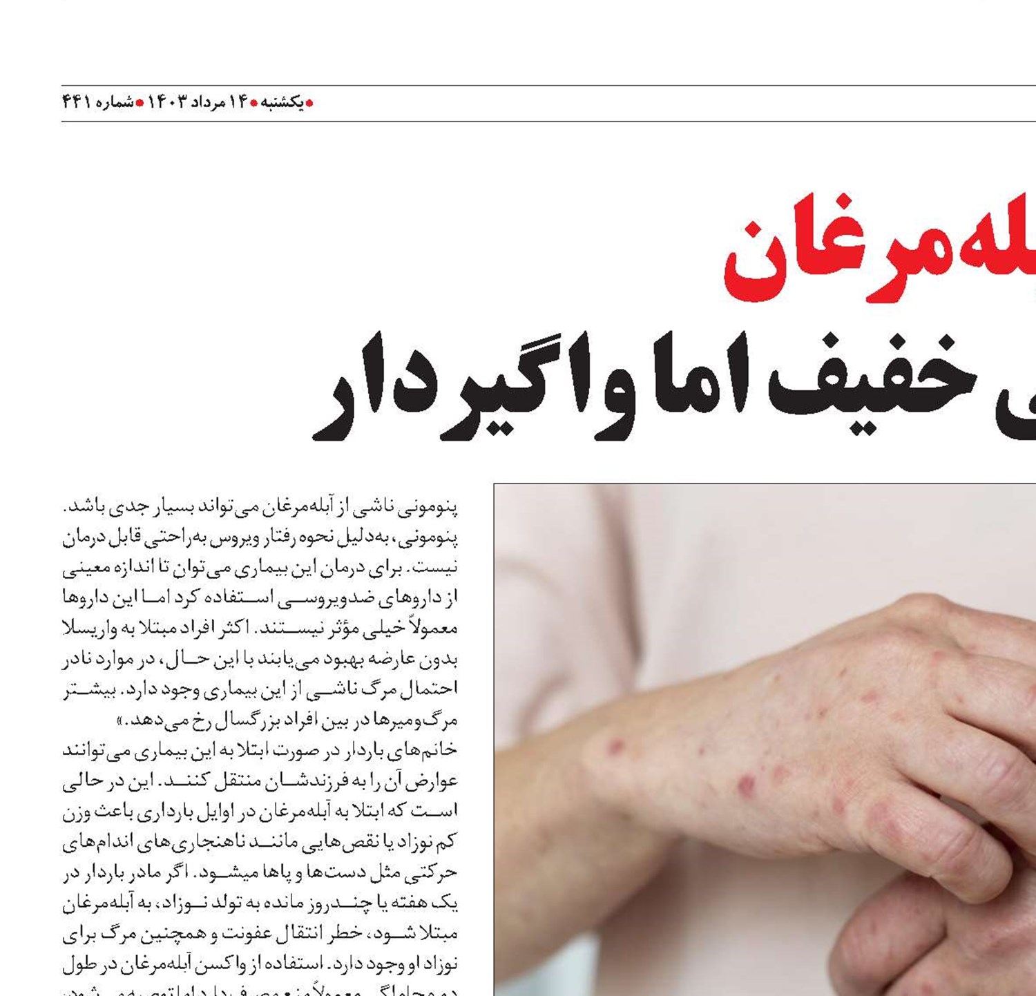 آبله‌مرغان بیماری عفونی خفیف اما واگیردار