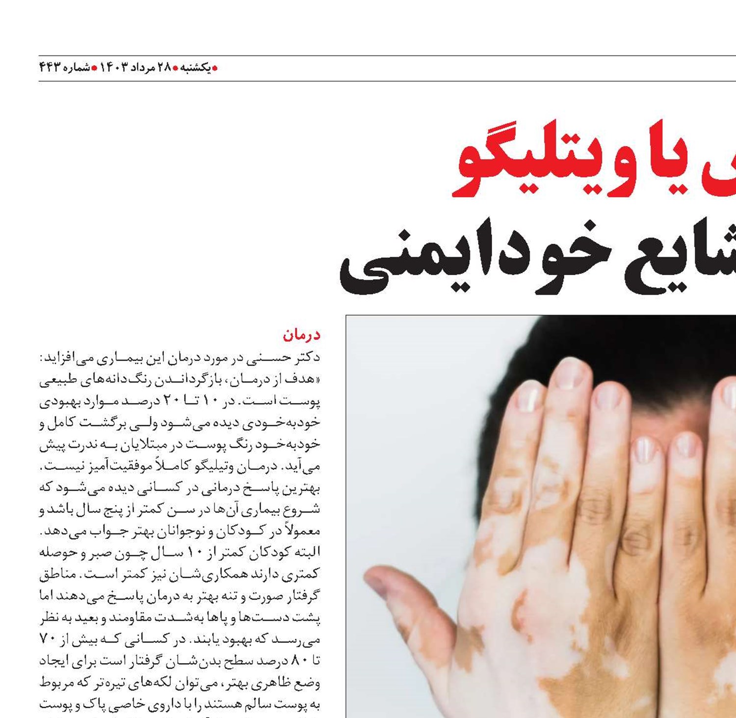 برص یا ویتلیگو بیماری شایع خودایمنی