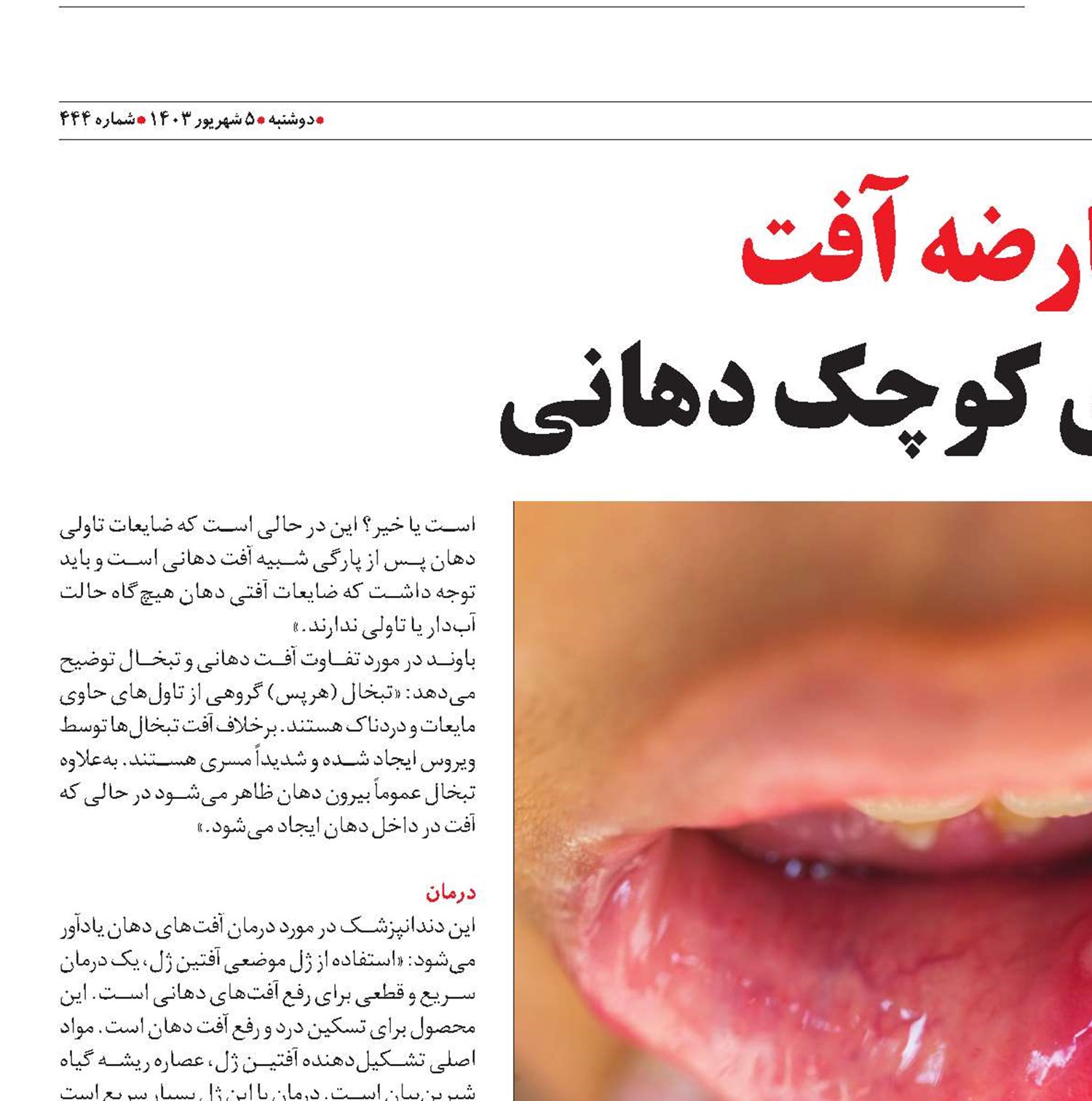 عارضه آفت‌ زخم های کوچک دهانی