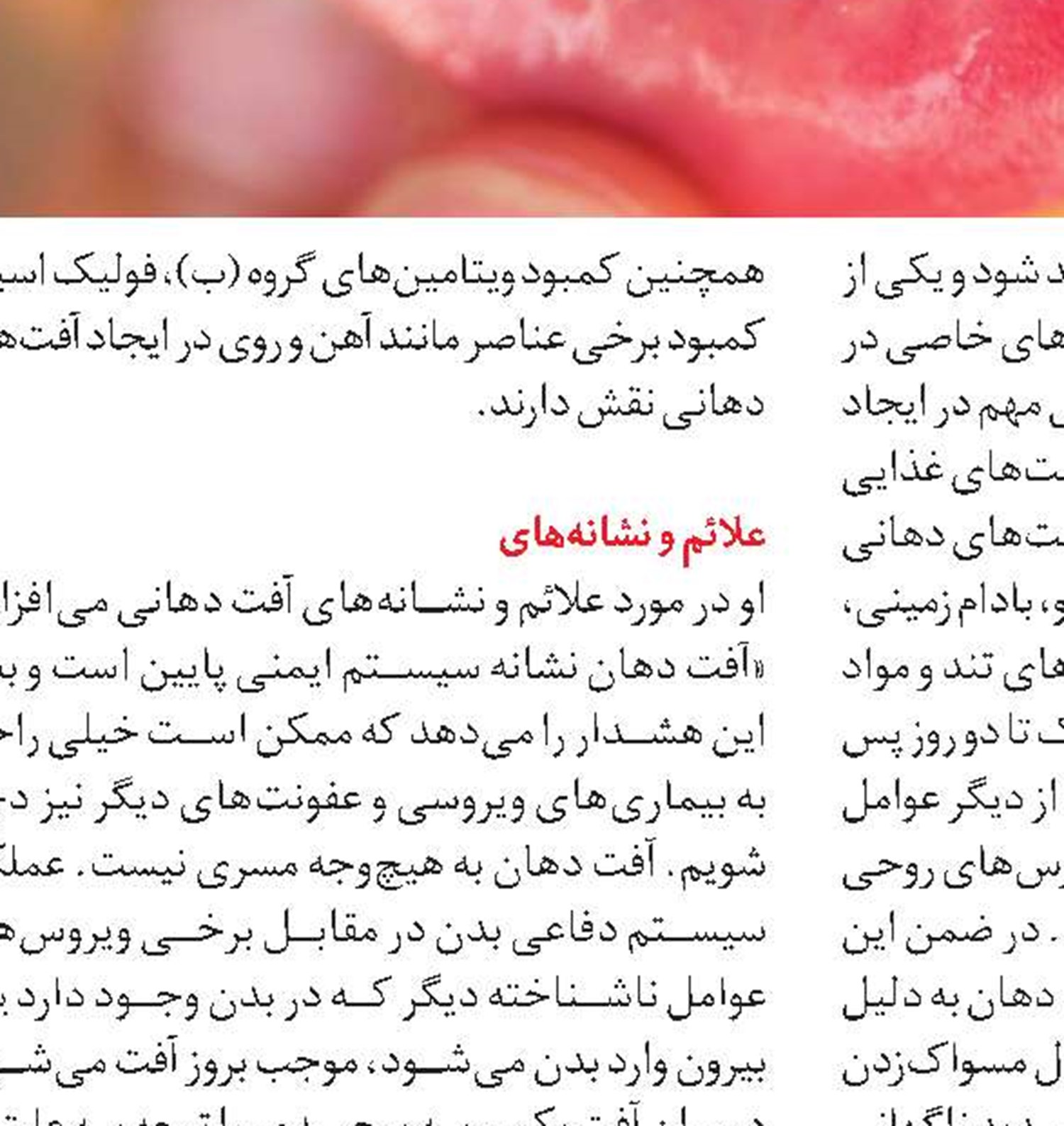 راه‌های پیشگیری از آفت دهان