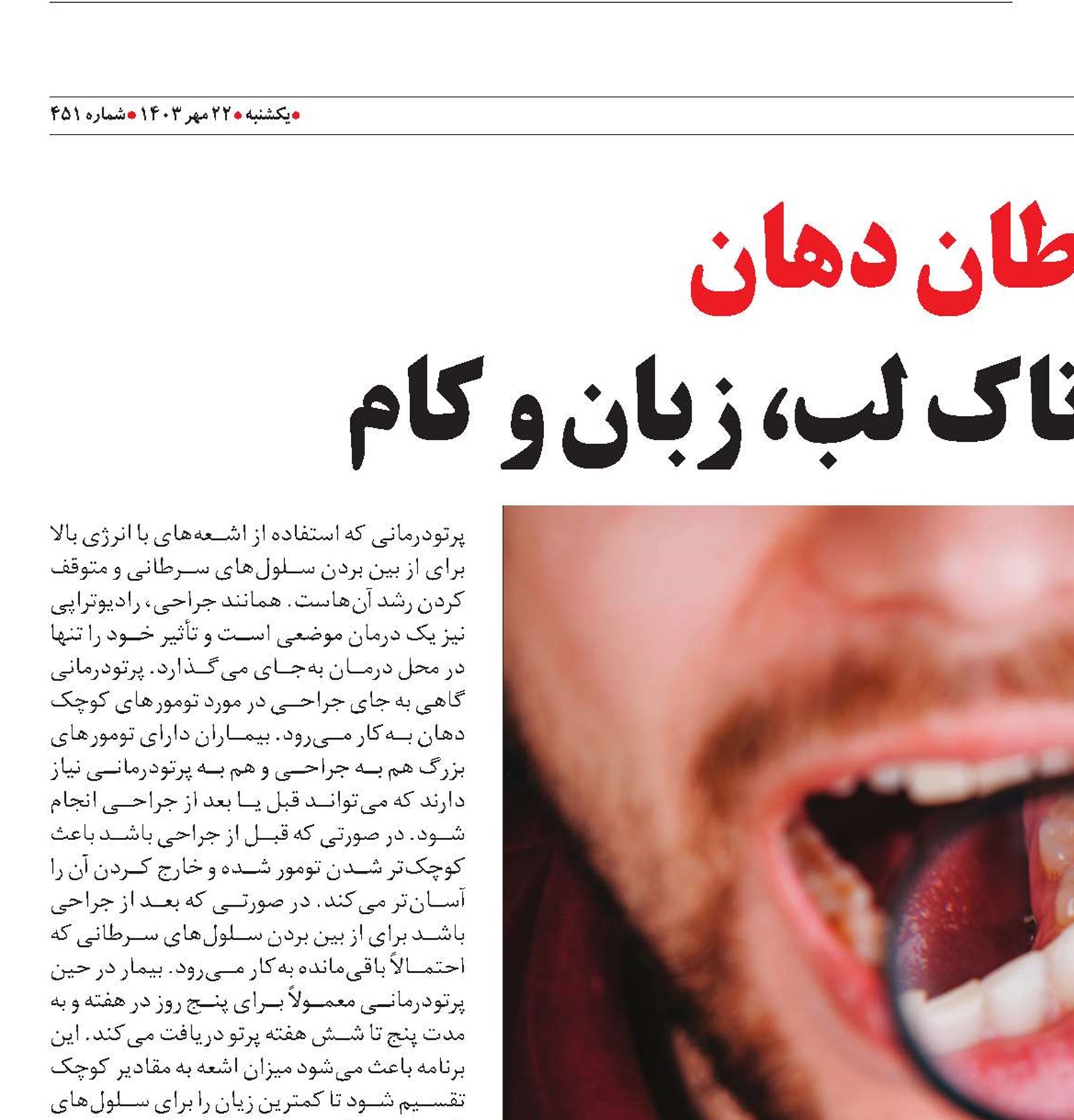 سرطان دهان بیماری دردناک لب، زبان و کام