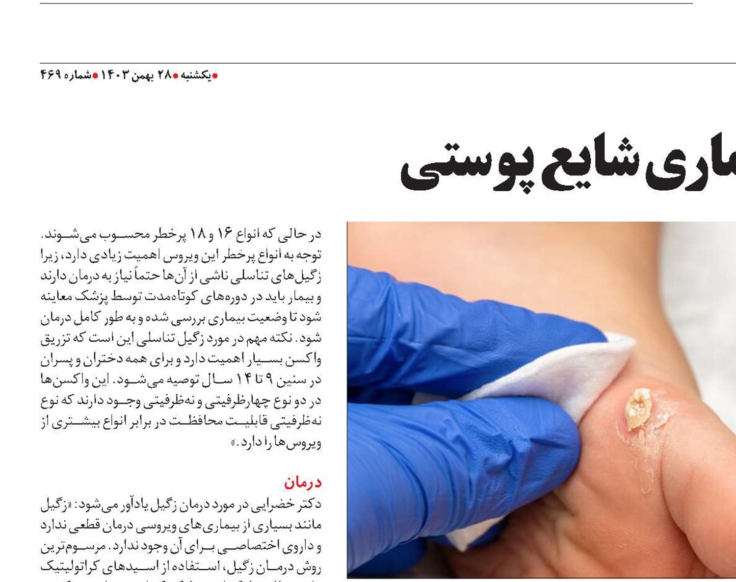 زگیل، بیماری شایع پوستی 