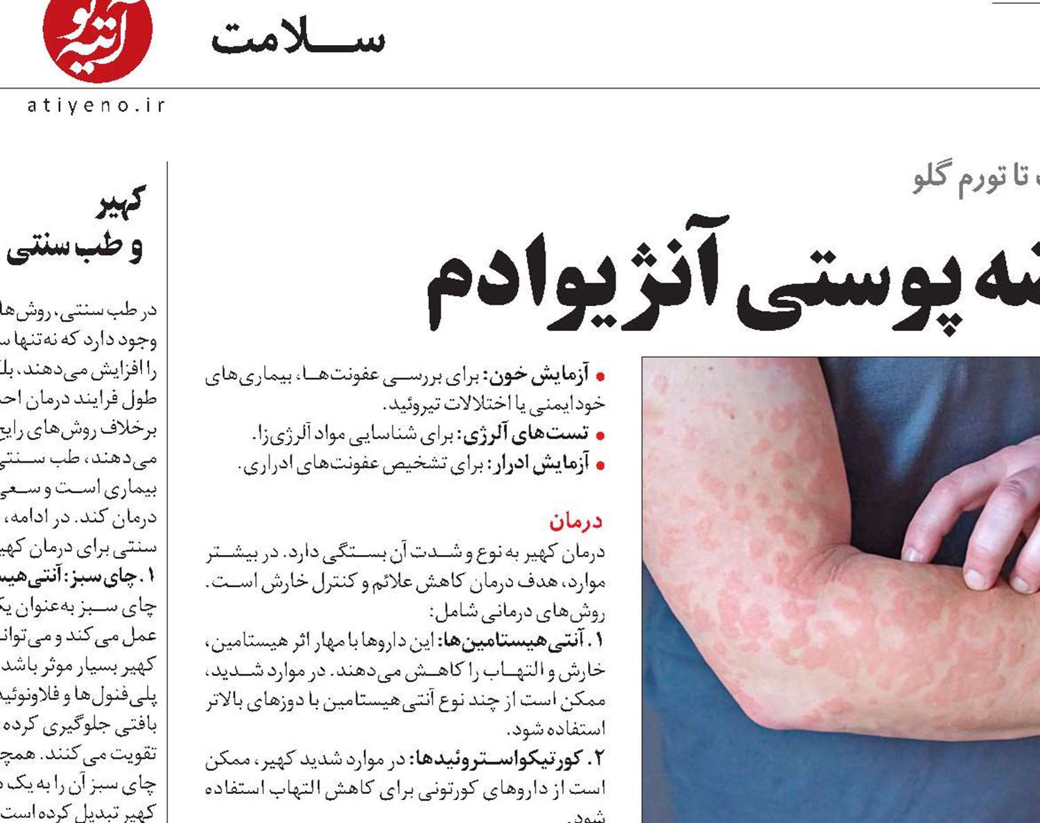 همه‌چیز درباره عارضه پوستی آنژیوادم